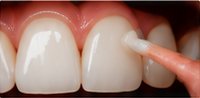 Bonding on front tooth