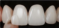Veneers held up to teeth