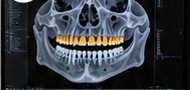 3D jaw scan with implant plan