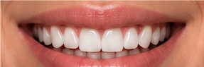 After Invisalign