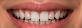 Before Invisalign