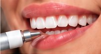 Teeth polishing close-up