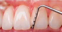 Gum probe on teeth