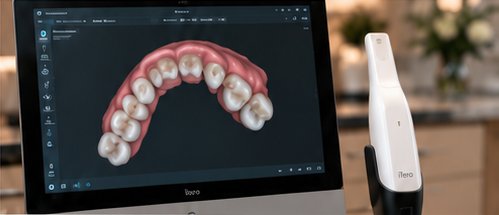 Digital dental scan on screen