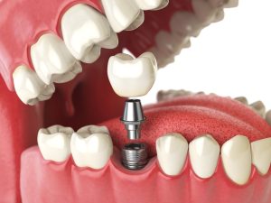 Jersey City Dentists Implant Services 3 Jersey City Dental Implants