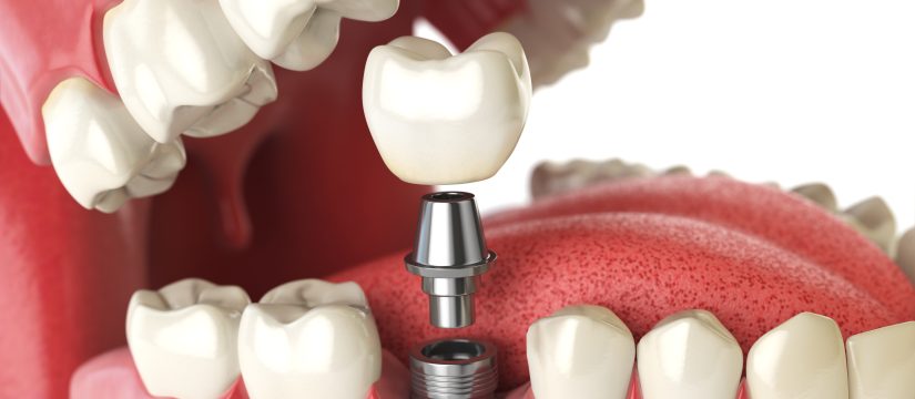 Jersey City Dental Implants